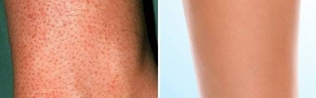 الدليل الكامل لعلاج جلد الوزّة والشعر تحت الجلد بدون ألم